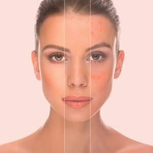 You Are Pretty Micro Needling Akne Therapie Behandlung