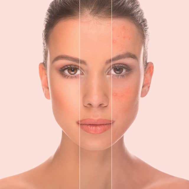 You Are Pretty Micro Needling Akne Therapie Behandlung