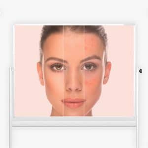 You Are Pretty Micro Nano Needling Schulung