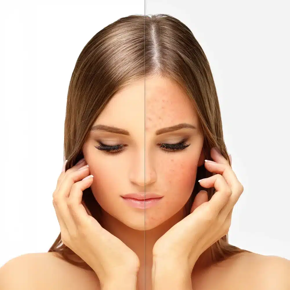 You Are Pretty Ozon Cold Plasma Behandlung