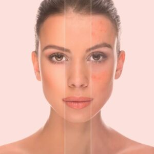 Micro Needling Behandlung